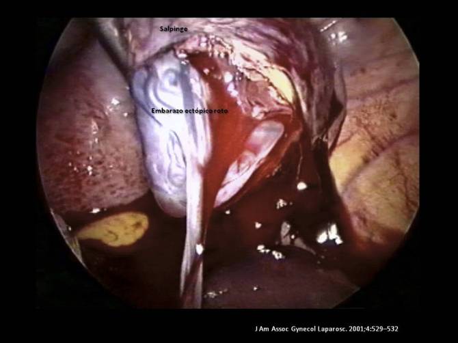 Embarazo ectópico