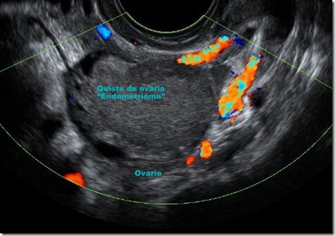 Endometriosis Ovárica