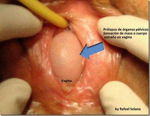 prolapso-de-organos-pelvicos_thumb1