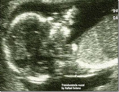 translucencia-nucal_thumb1